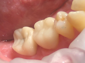 CEREC vs. Traditional Crowns